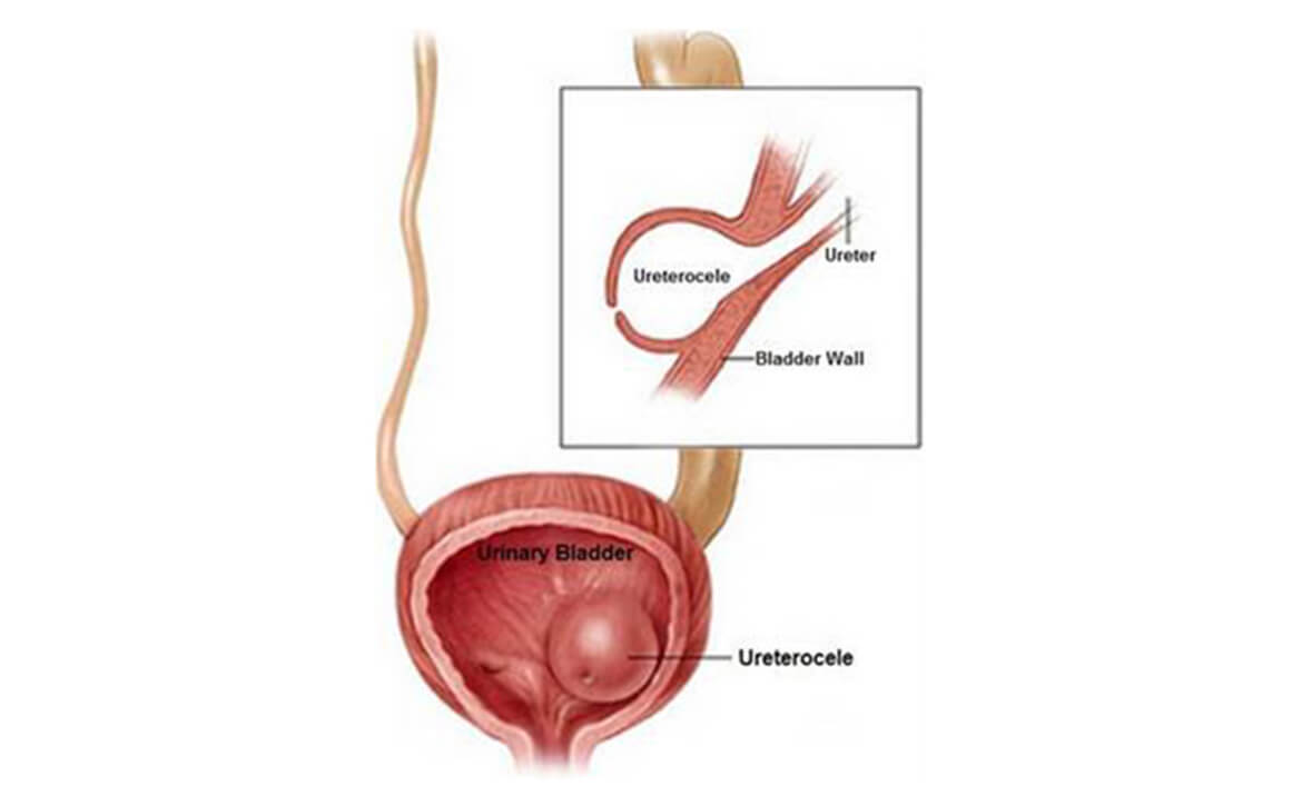 Meilleur urologue pédiatrique en Inde, urologie pédiatrique robotique