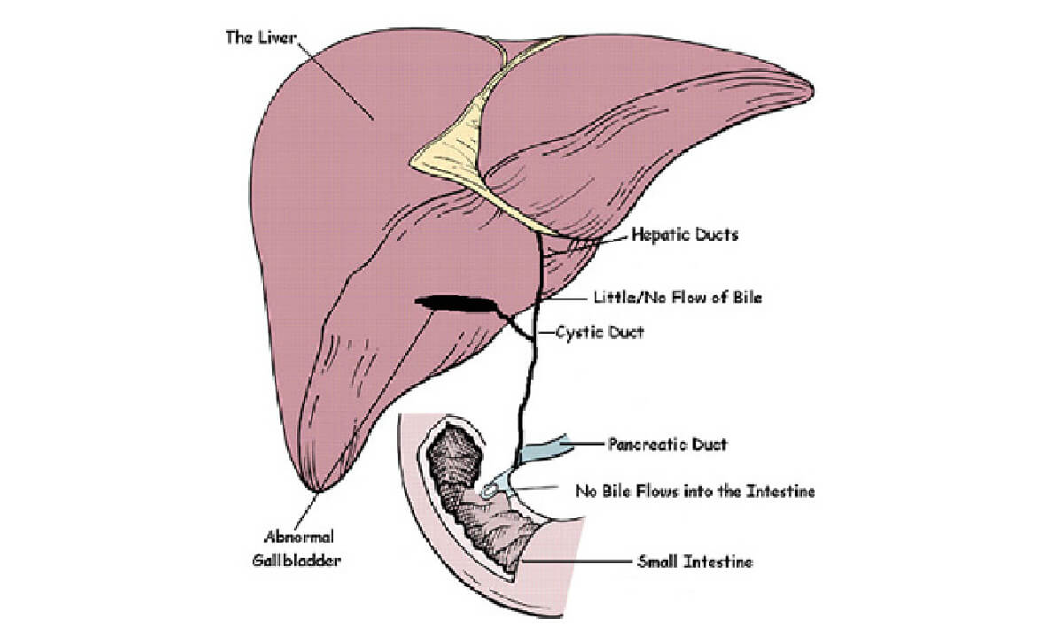 Atrésie biliaire extra-hépatique (EHBA), chirurgien gastro-entérologue en Inde