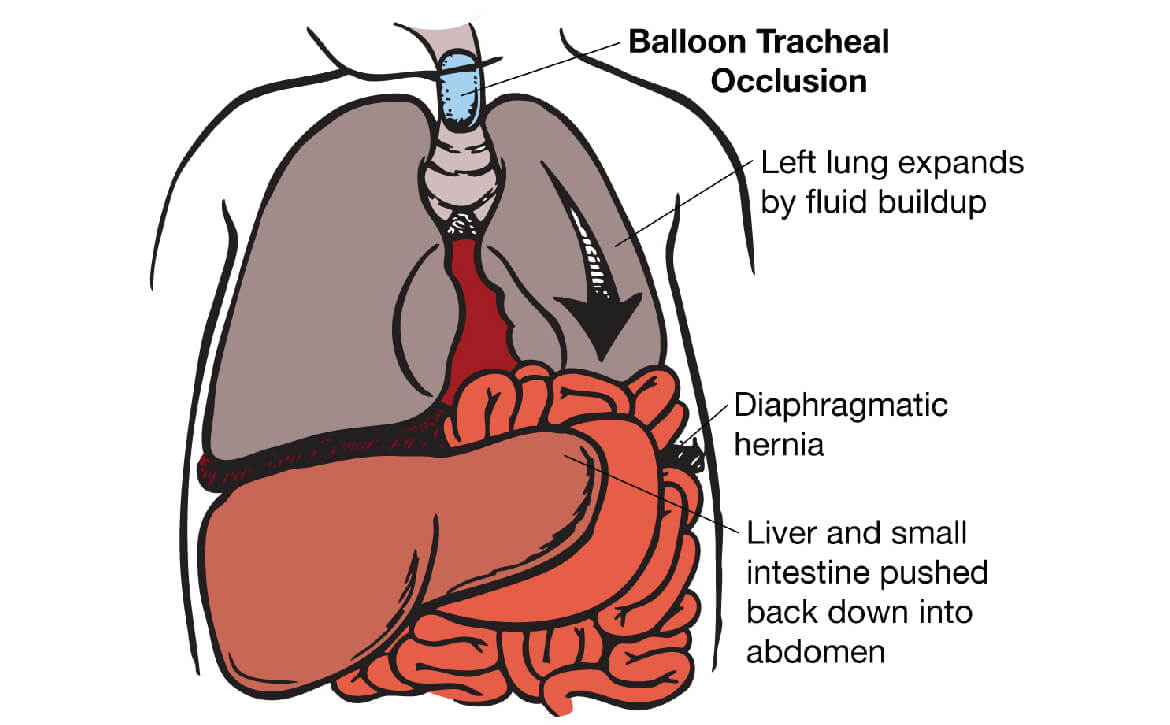 Hernie diaphragmatique congénitale (CDH), chirurgien gastroentérologue en Inde