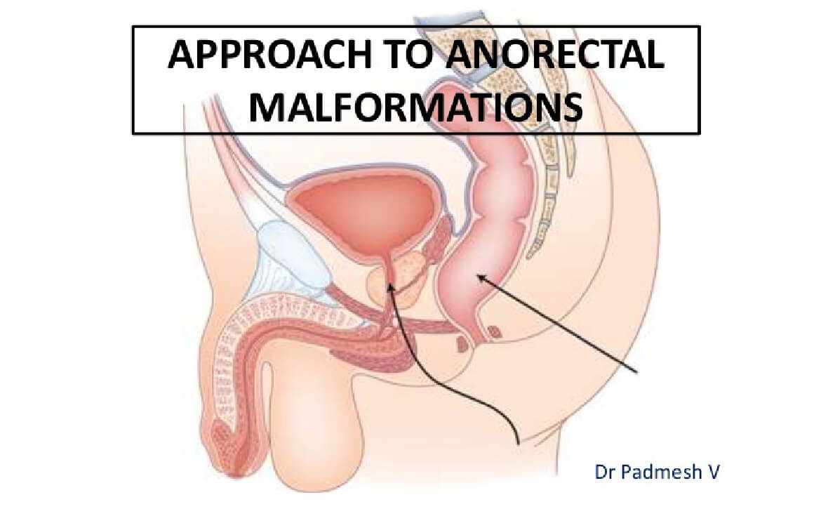 Malformation anorectale élevée (ARM), chirurgien gastroentérologue en Inde