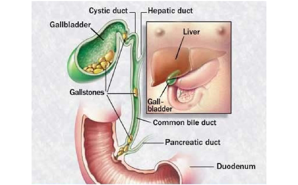 Cholécystectomie laparoscopique, chirurgien gastro-entérologue en Inde