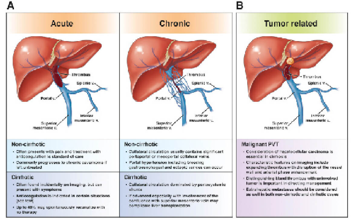 Obstruction extrahépatique de la veine porte avec hypertension porte